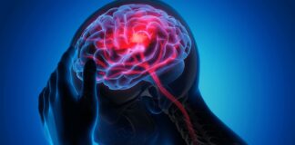 AVC: 9 em cada 10 casos poderiam ser evitados, alerta especialista